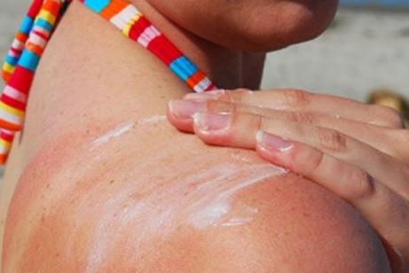 Što znači bolje opekline od sunca - tajne lijepe i zdrave kože