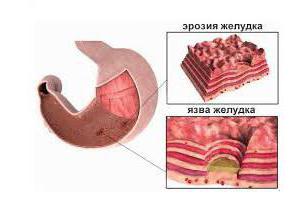 Erozivni gastritis kod MKB 10