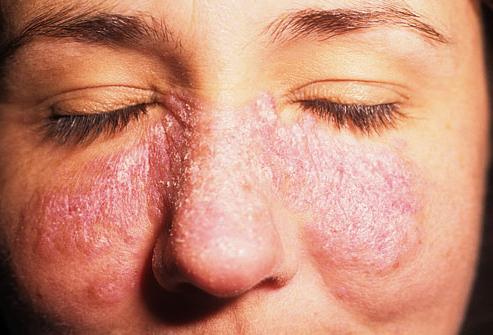 Zašto koža leti na licu? Uzroci i liječenje